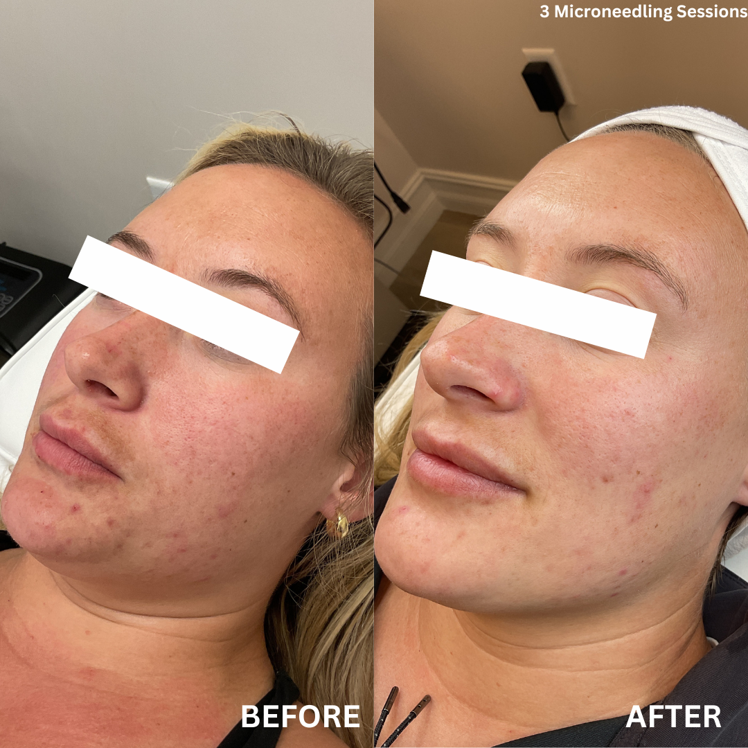 Before & After Microneedling