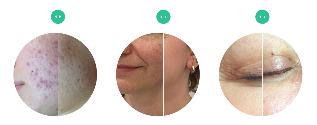 Discover BioRePeel: The No-Downtime Chemical Peel for Radiant Skin in Naples, FL