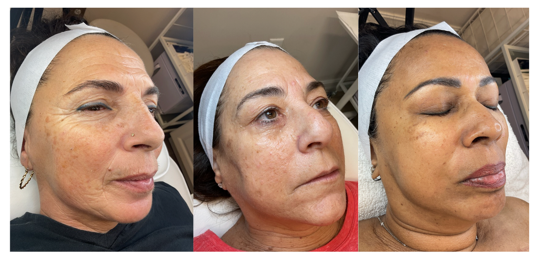 Microneedling with exosomes: What actually works