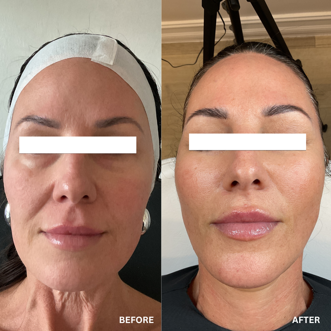 Microneedling + Hydrofacials